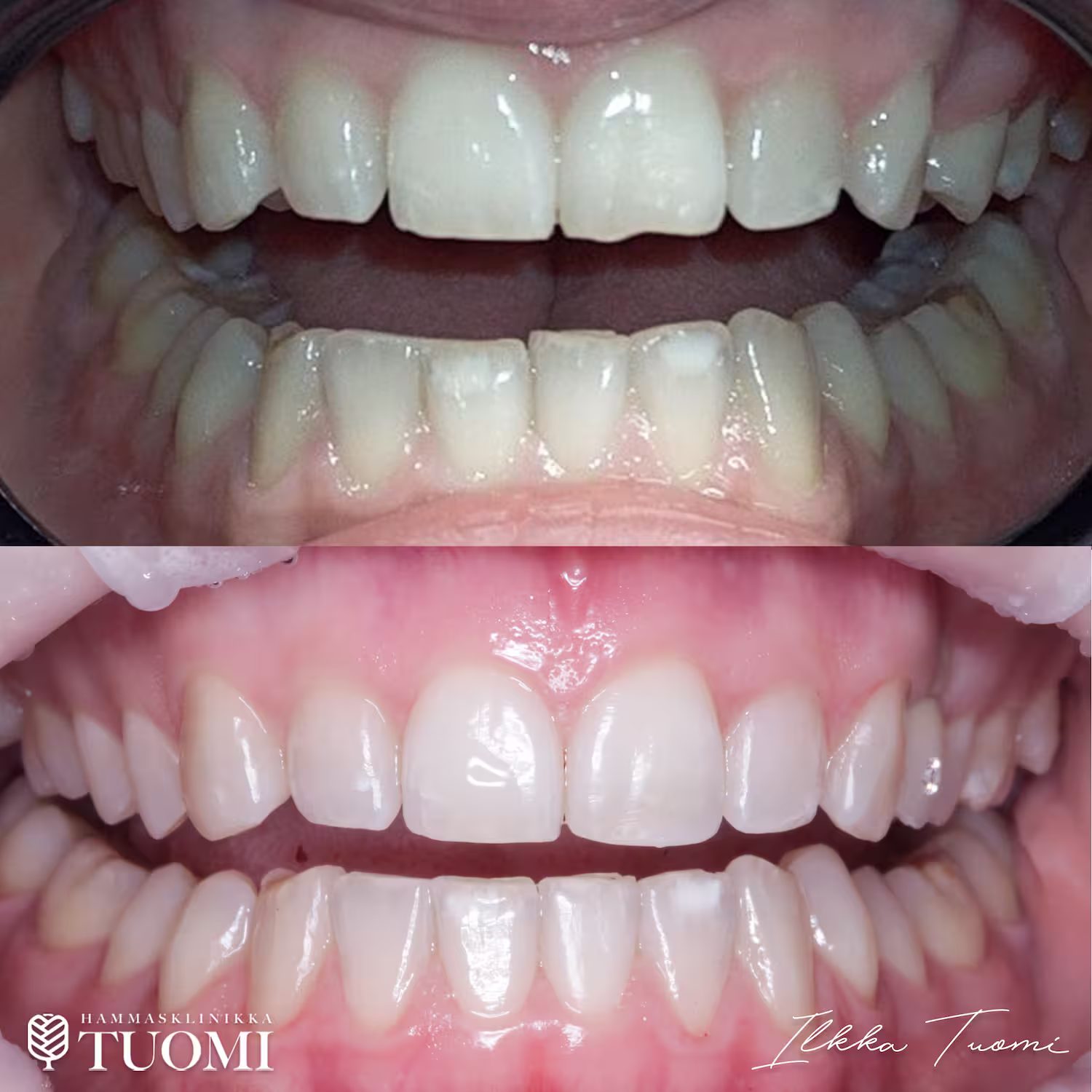 hammastuomi_invisalign2 invisalign