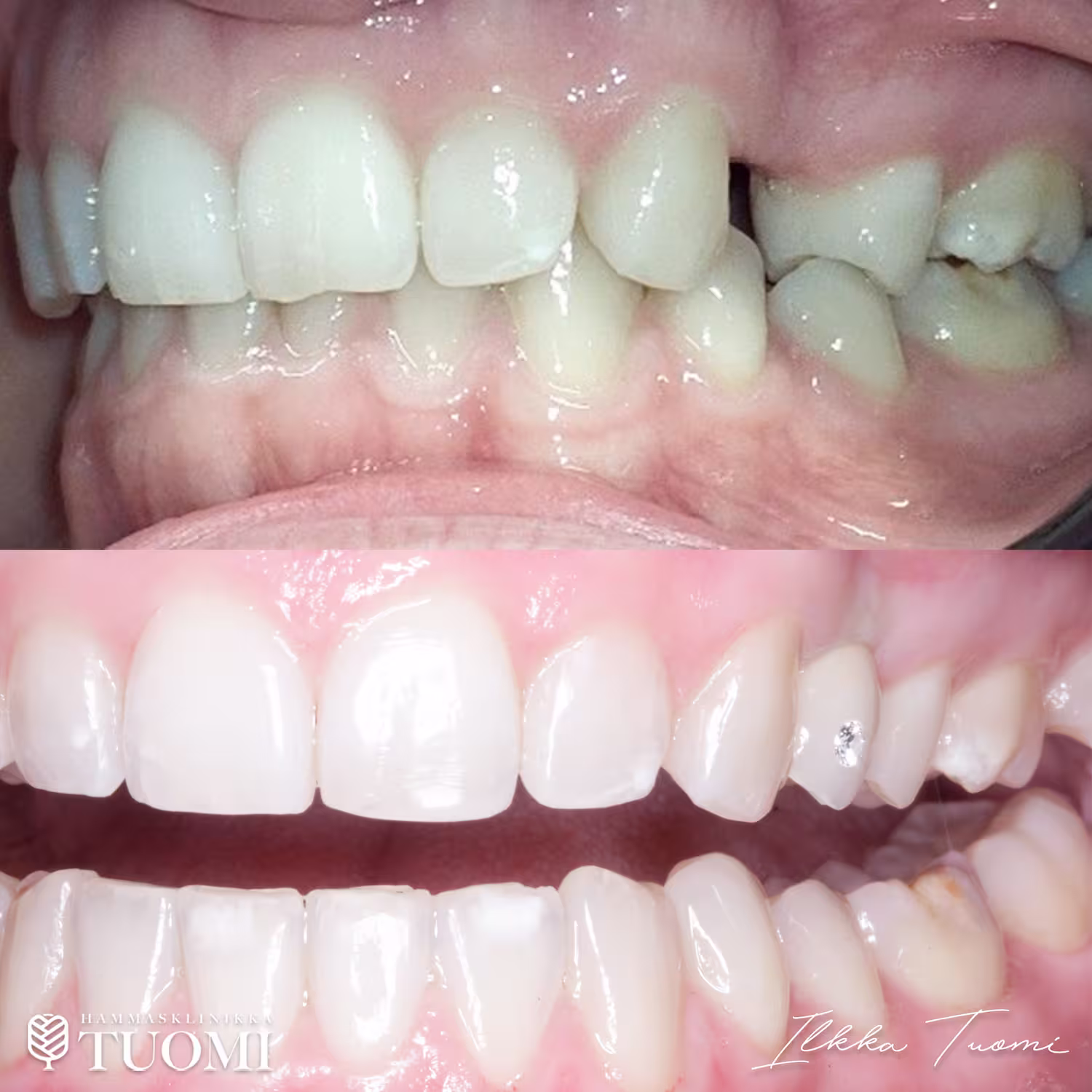 hammastuomi_invisalign3 invisalign