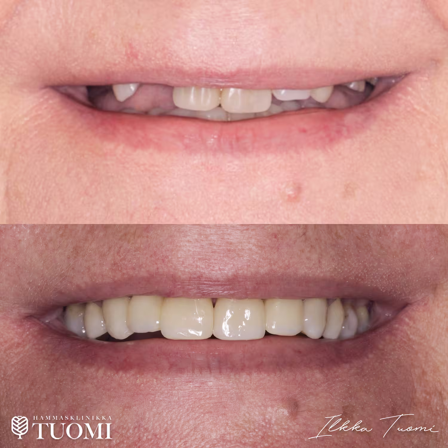 kuluneen purennan hoito keramialla ja muovilla1