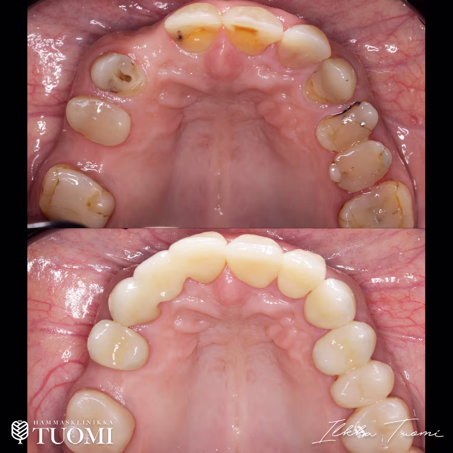 kuluneen purennan hoito keramialla ja muovilla2