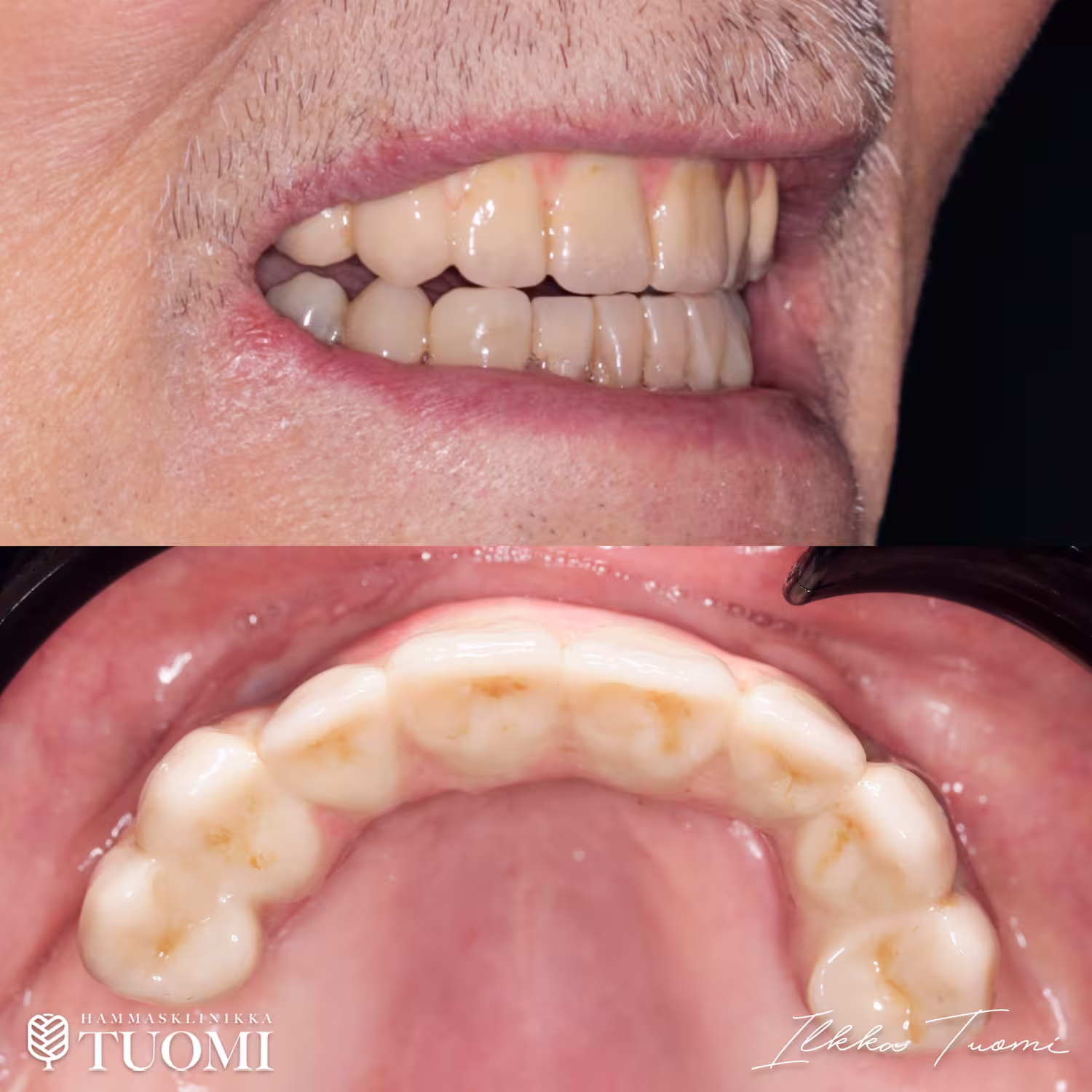 kuluneiden alahampaiden hoito2